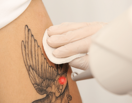 Laser Tattoo Removal | Padra Medical Center